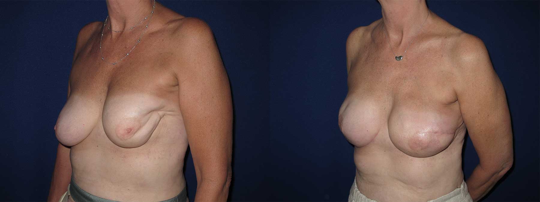 Before and After Image of Latissimus Flap Breast Reconstruction