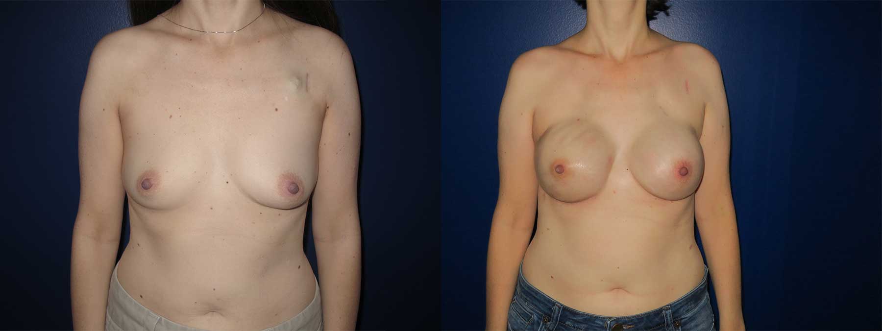 Before and After Image of Latissimus Flap Breast Reconstruction