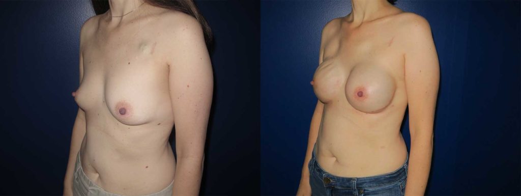 Before and After Image of Latissimus Flap Breast Reconstruction