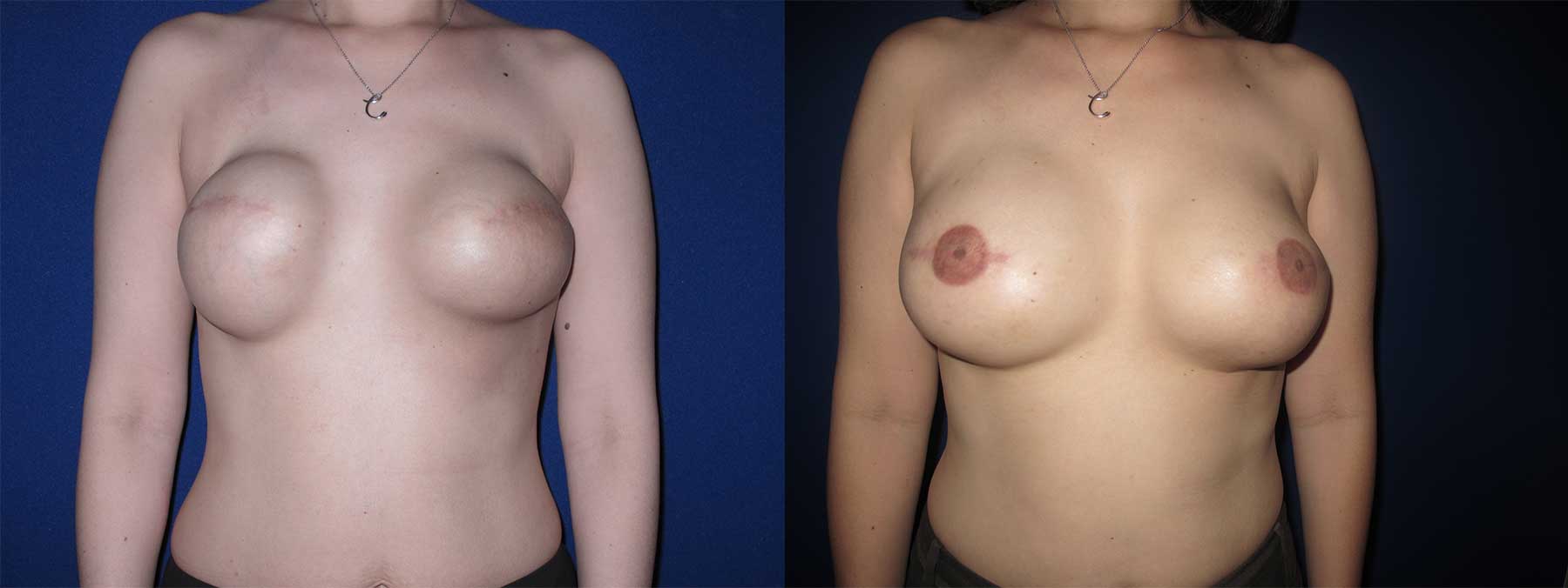 Before and After Image of Latissimus Flap Breast Reconstruction