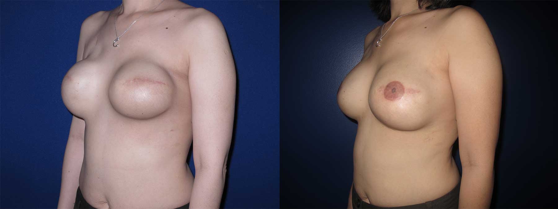 Before and After Image of Latissimus Flap Breast Reconstruction