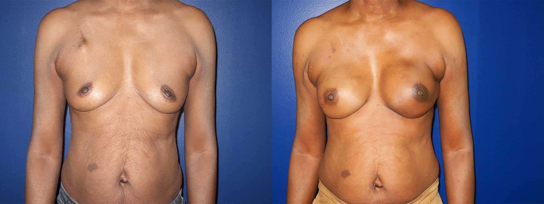 Before and After Image of Latissimus Flap Breast Reconstruction