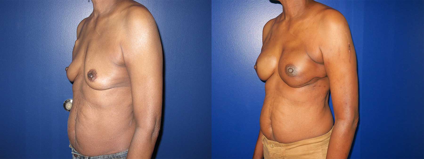 Before and After Image of Latissimus Flap Breast Reconstruction