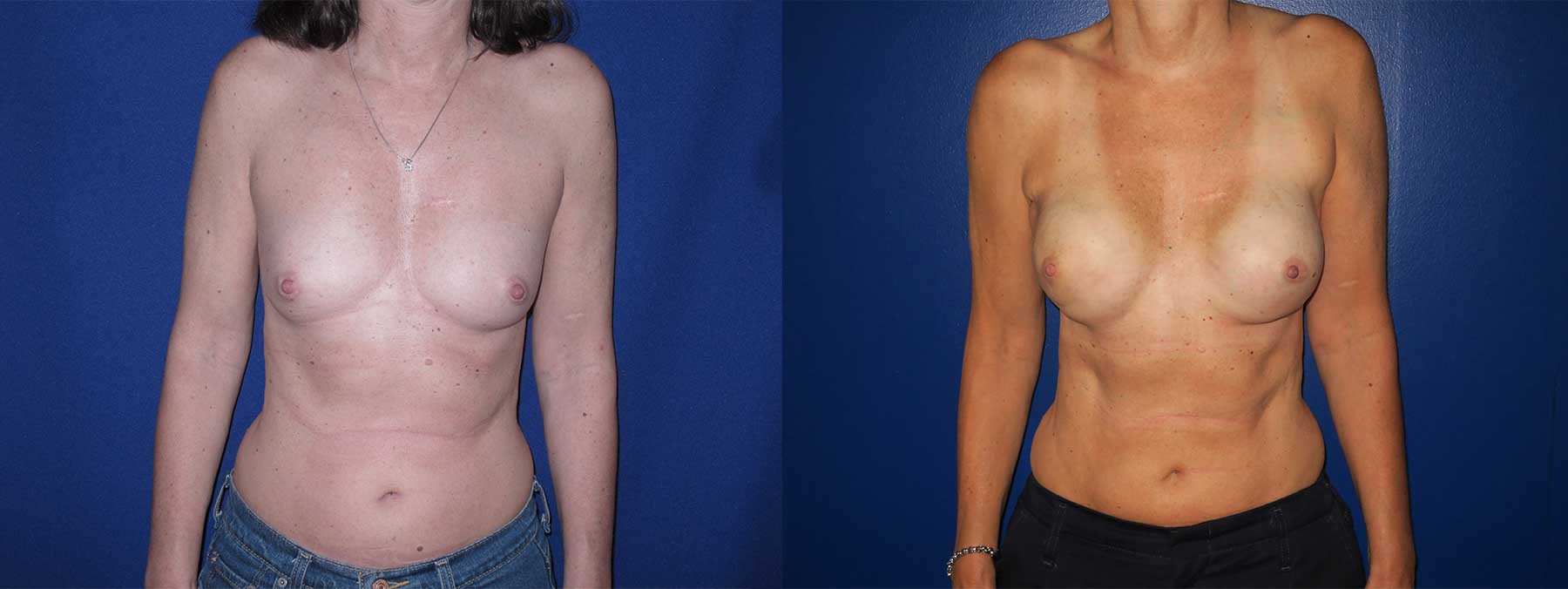 Before and After Image of Latissimus Flap Breast Reconstruction