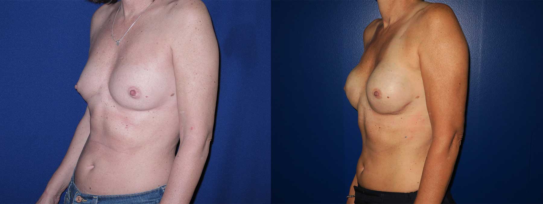 Before and After Image of Latissimus Flap Breast Reconstruction