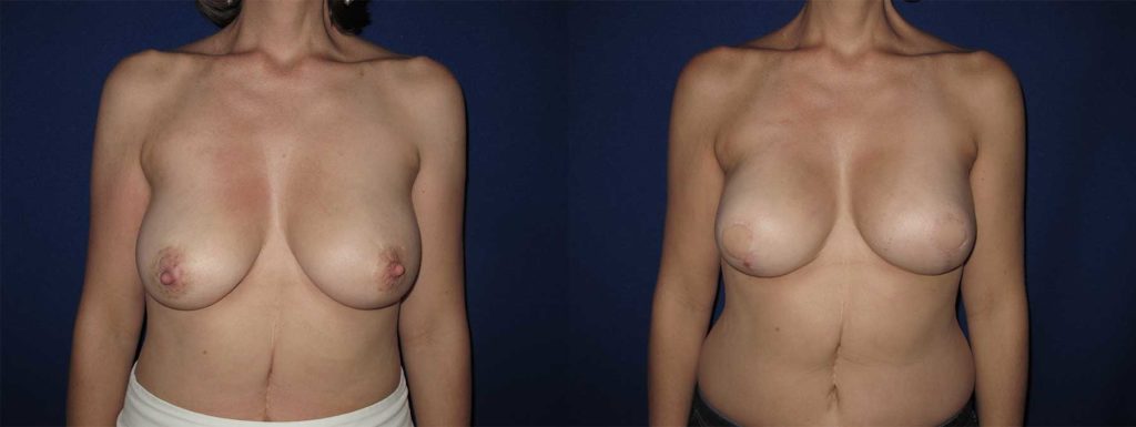 Before and After Image of Latissimus Flap Breast Reconstruction