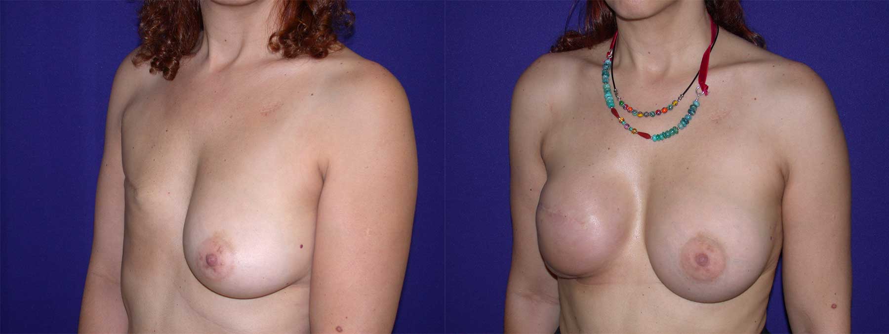 Before and After Image of Latissimus Flap Breast Reconstruction