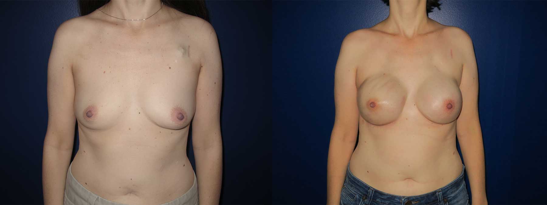 Before and After Image of Nipple Sparing Reconstruction