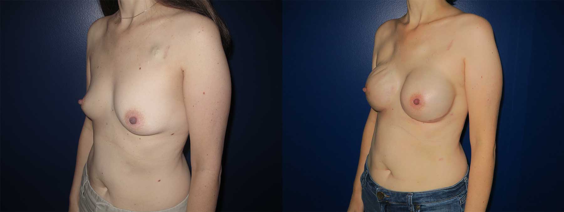 Before and After Image of Nipple Sparing Reconstruction