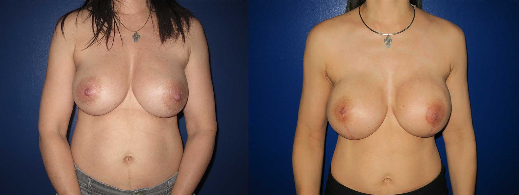 Before and After Image of Nipple Sparing Reconstruction