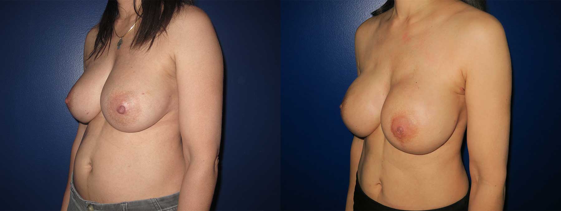 Before and After Image of Nipple Sparing Reconstruction