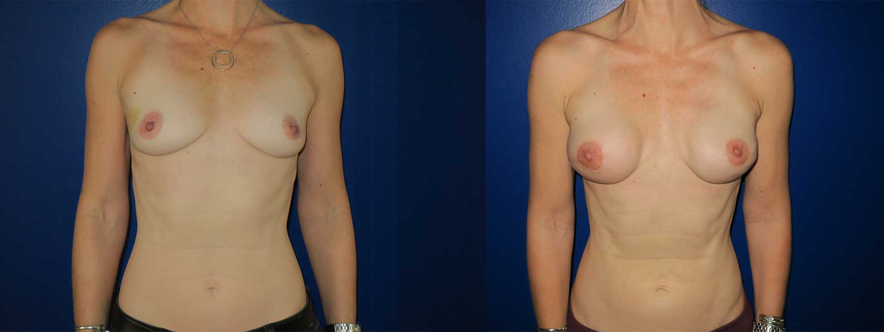 Before and After Image of Nipple Sparing Reconstruction