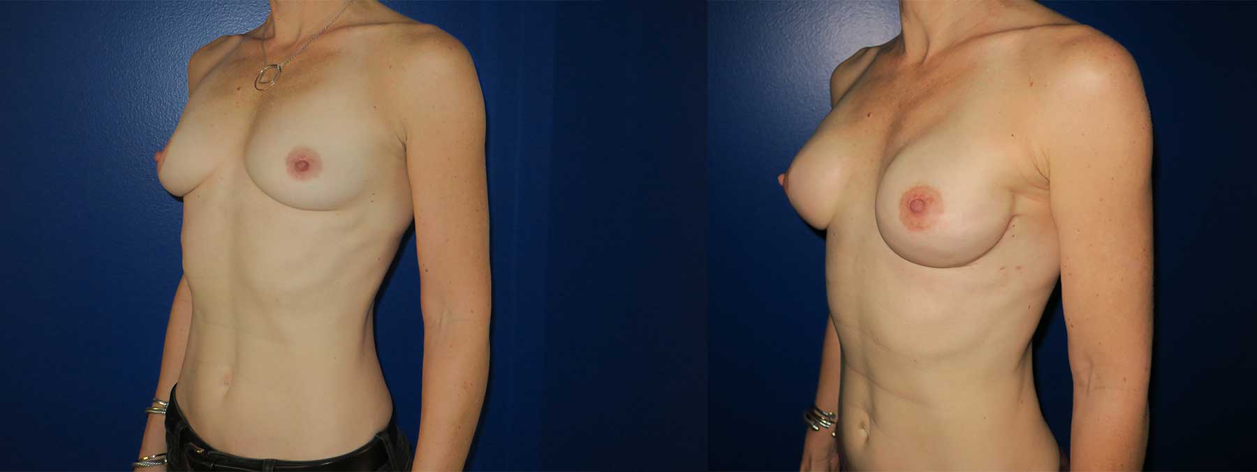 Before and After Image of Nipple Sparing Reconstruction