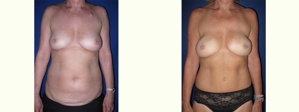 Before and After Image of Nipple Sparing Reconstruction