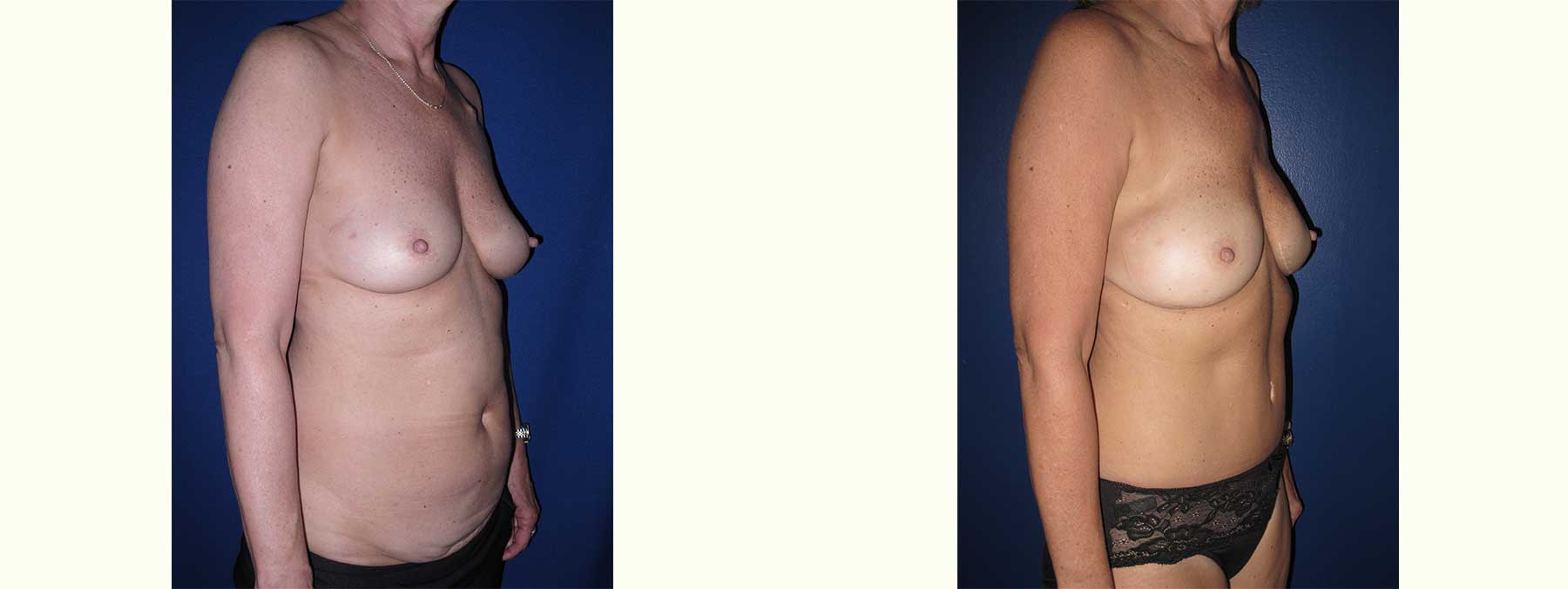 Before and After Image of Nipple Sparing Reconstruction