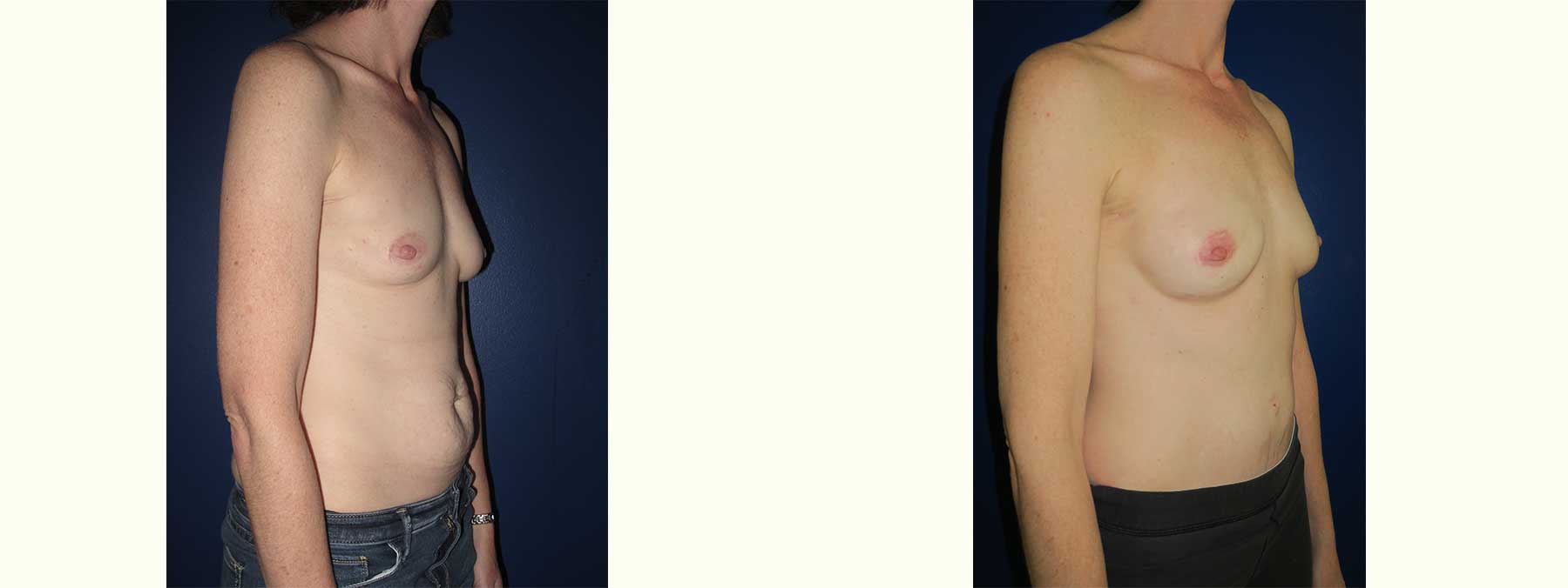 Before and After Image of Nipple Sparing Reconstruction