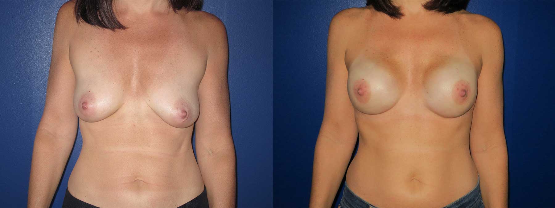 Before and After Image of Nipple Sparing Reconstruction