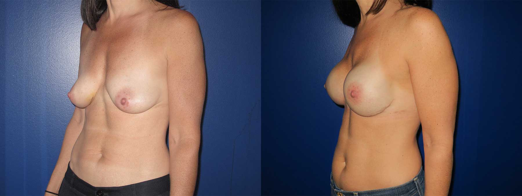 Before and After Image of Nipple Sparing Reconstruction