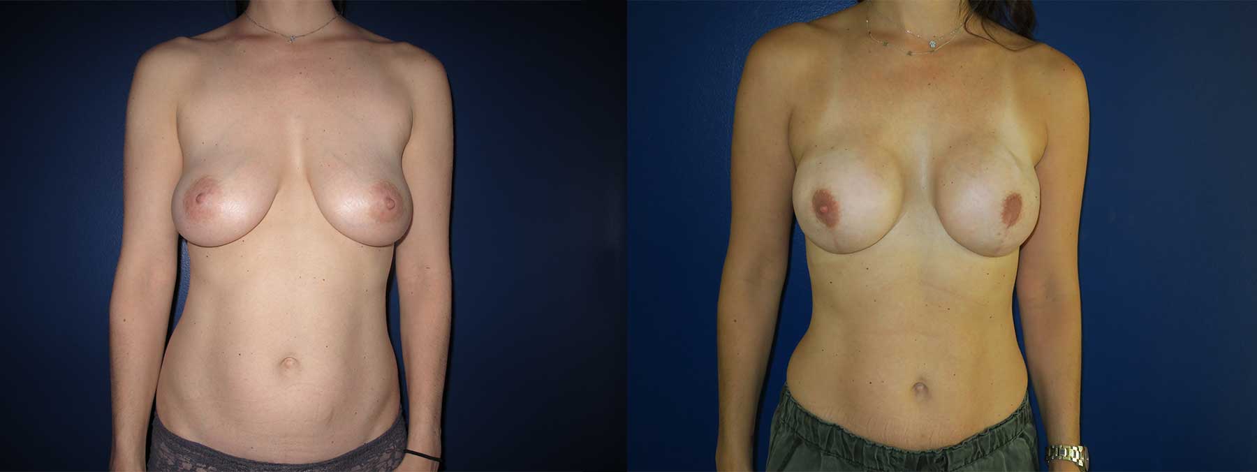 Before and After Image of Nipple Sparing Reconstruction