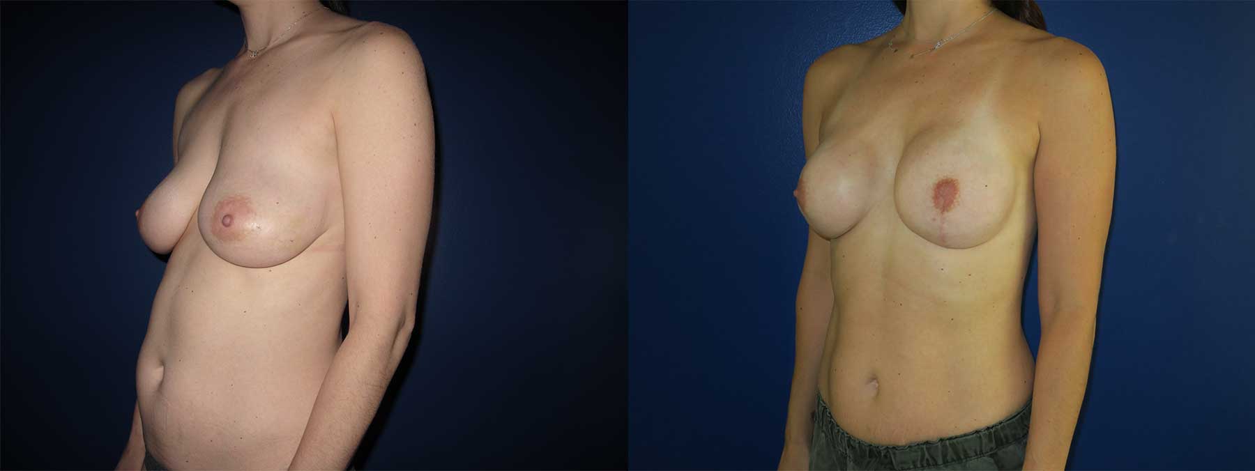 Before and After Image of Nipple Sparing Reconstruction