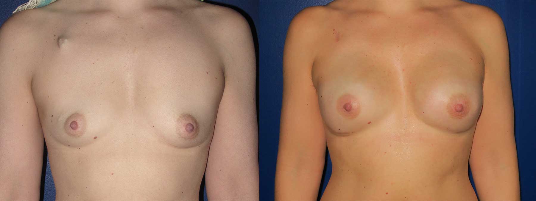 Before and After Image of Nipple Sparing Reconstruction