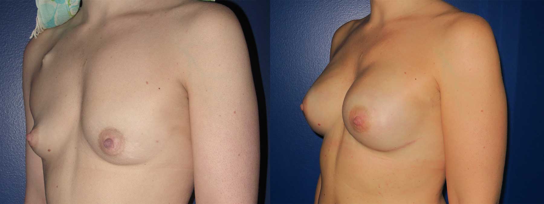 Before and After Image of Nipple Sparing Reconstruction