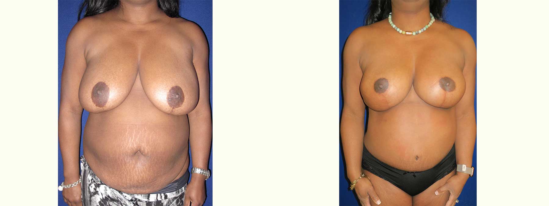 Before and After Image of Nipple Sparing Reconstruction