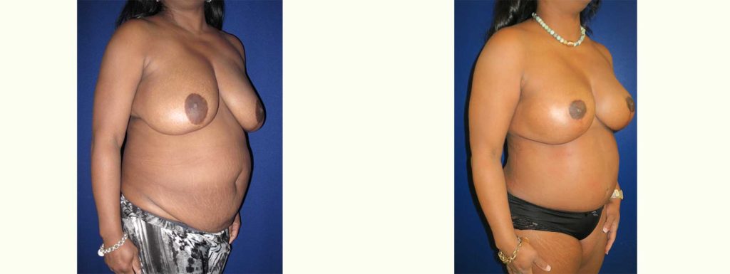Before and After Image of Nipple Sparing Reconstruction