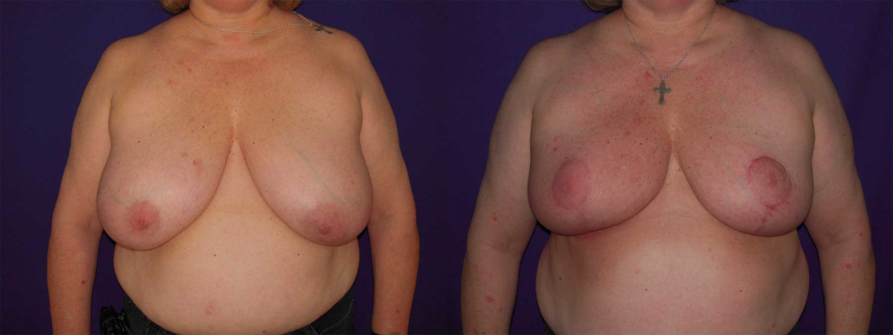 Before and After Image of Oncoplastic Breast Reconstruction