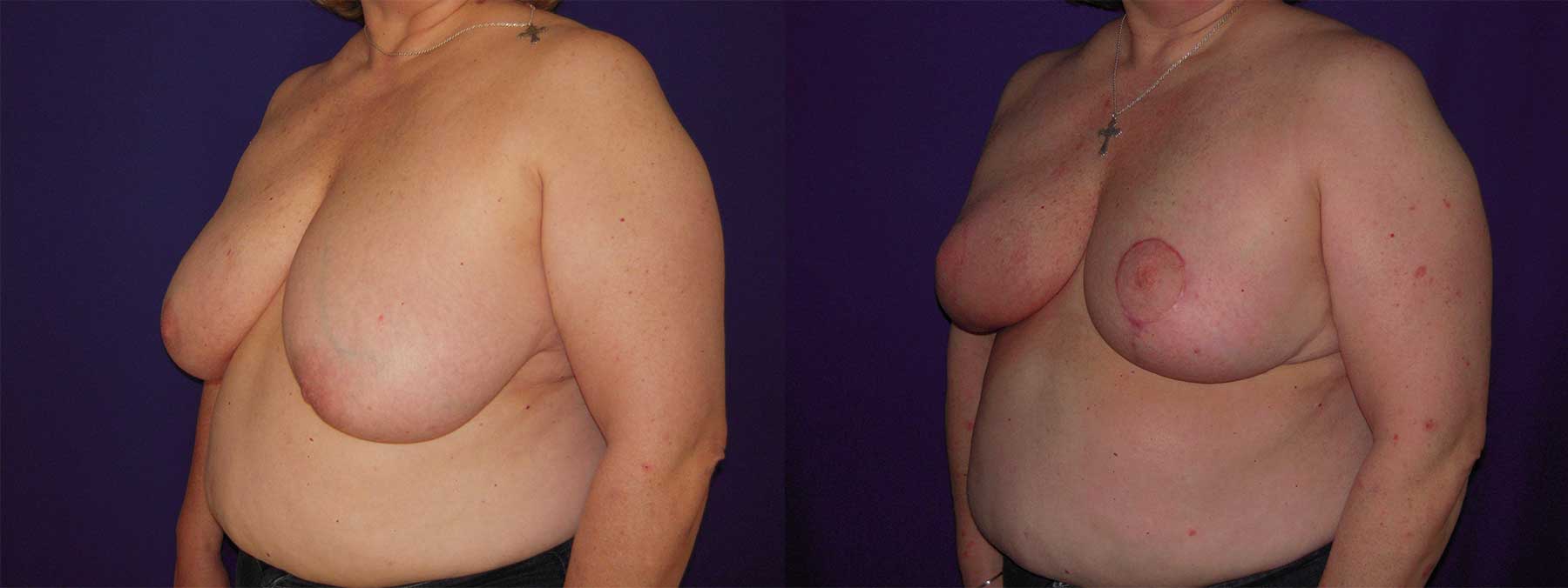 Before and After Image of Oncoplastic Breast Reconstruction