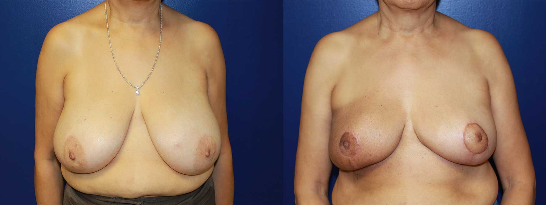 Before and After Image of Oncoplastic Breast Reconstruction