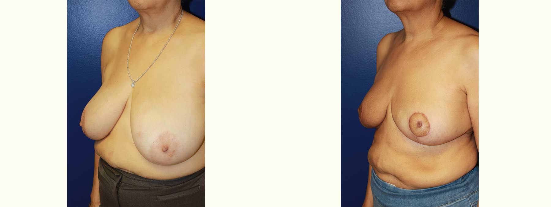 Before and After Image of Oncoplastic Breast Reconstruction