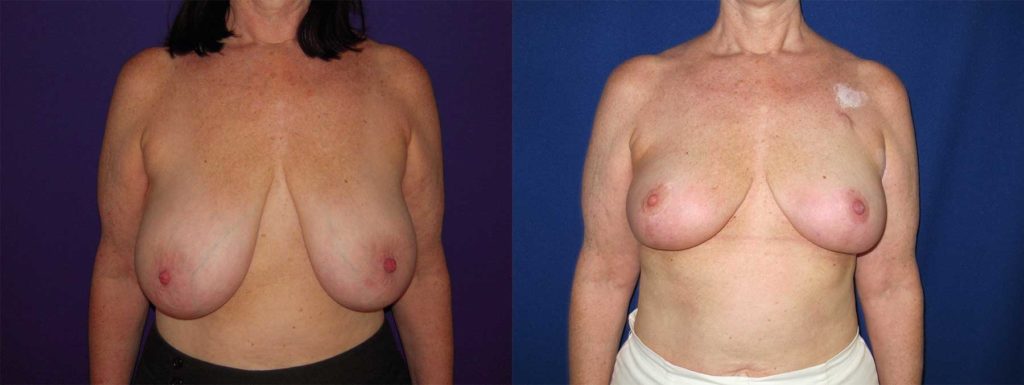 Before and After Image of Oncoplastic Breast Reconstruction