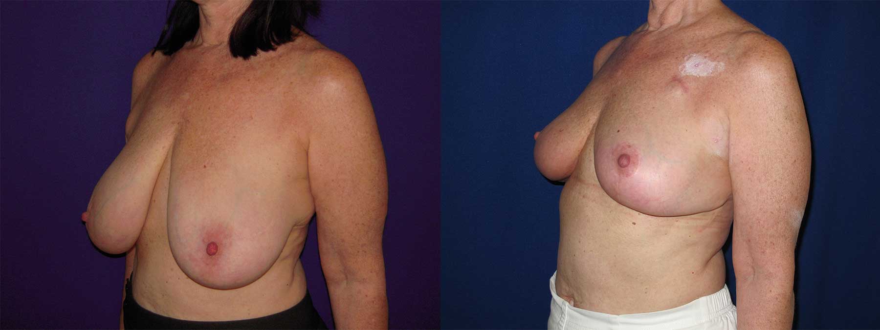 Before and After Image of Oncoplastic Breast Reconstruction