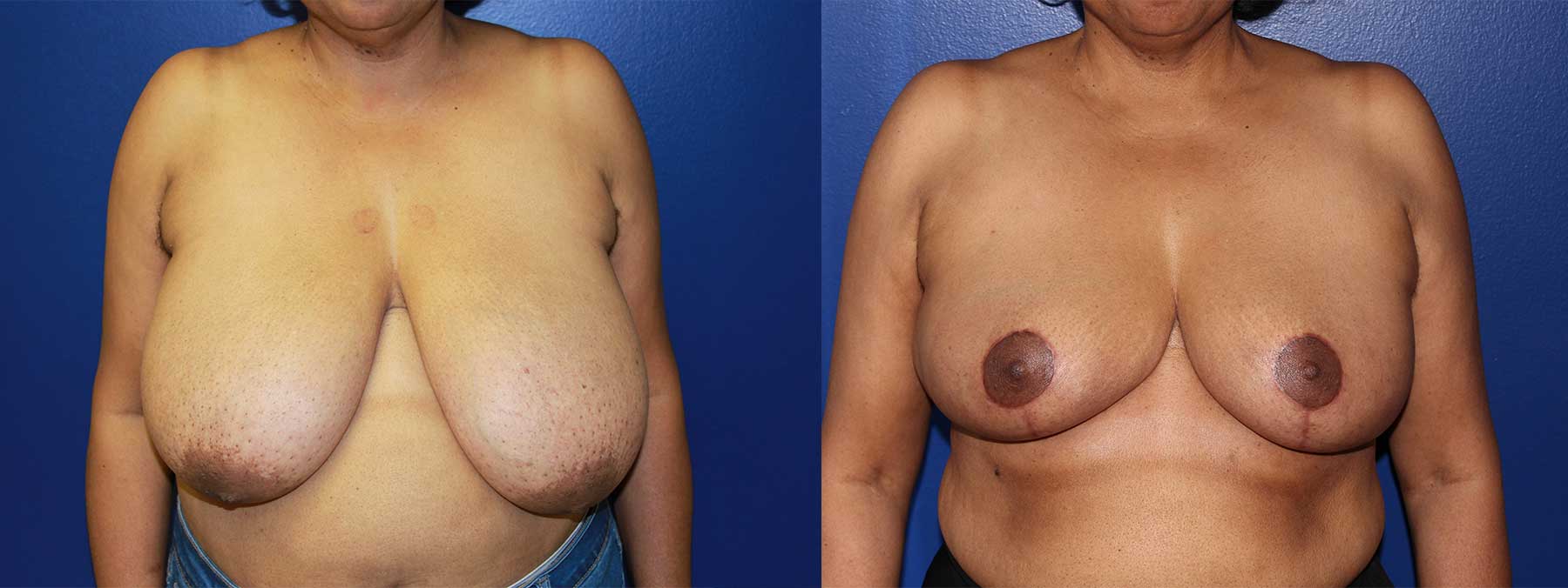 Before and After Image of Oncoplastic Breast Reconstruction