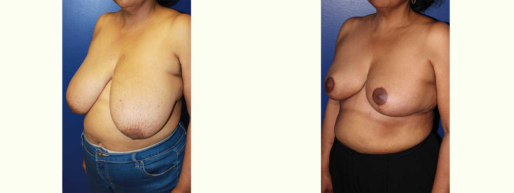 Before and After Image of Oncoplastic Breast Reconstruction