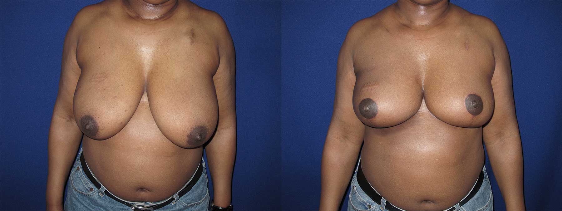 Before and After Image of Oncoplastic Breast Reconstruction