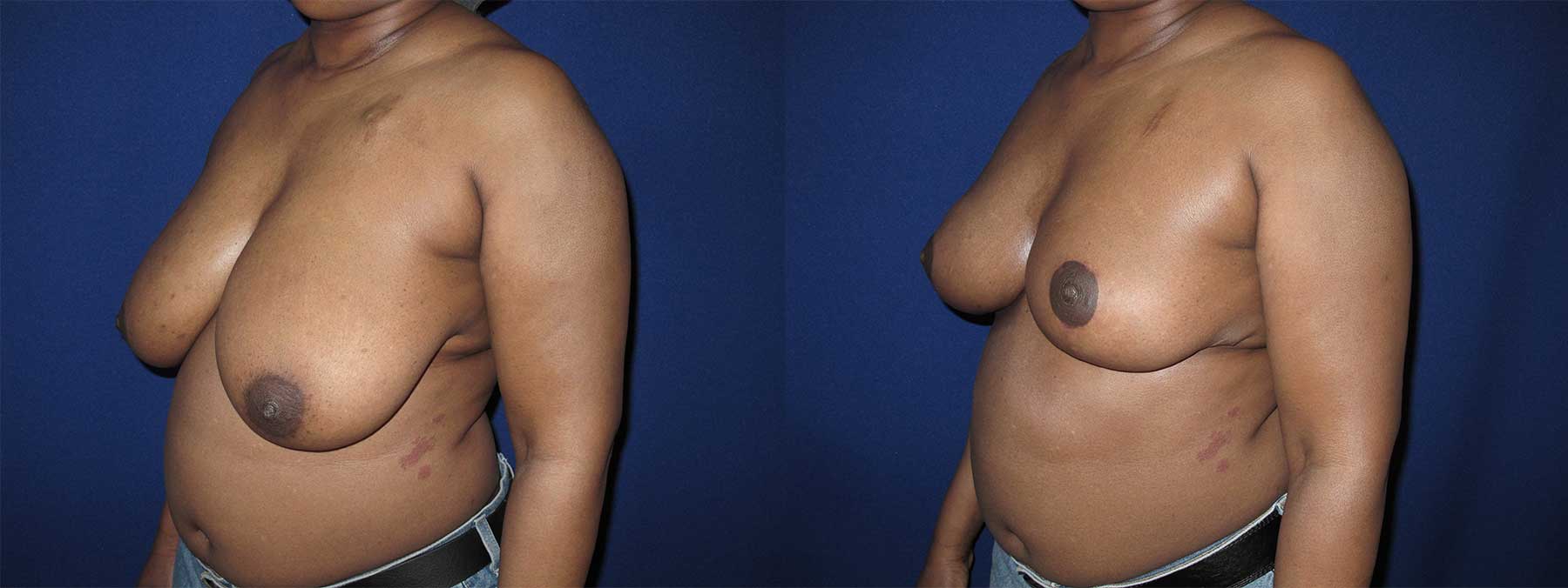 Before and After Image of Oncoplastic Breast Reconstruction