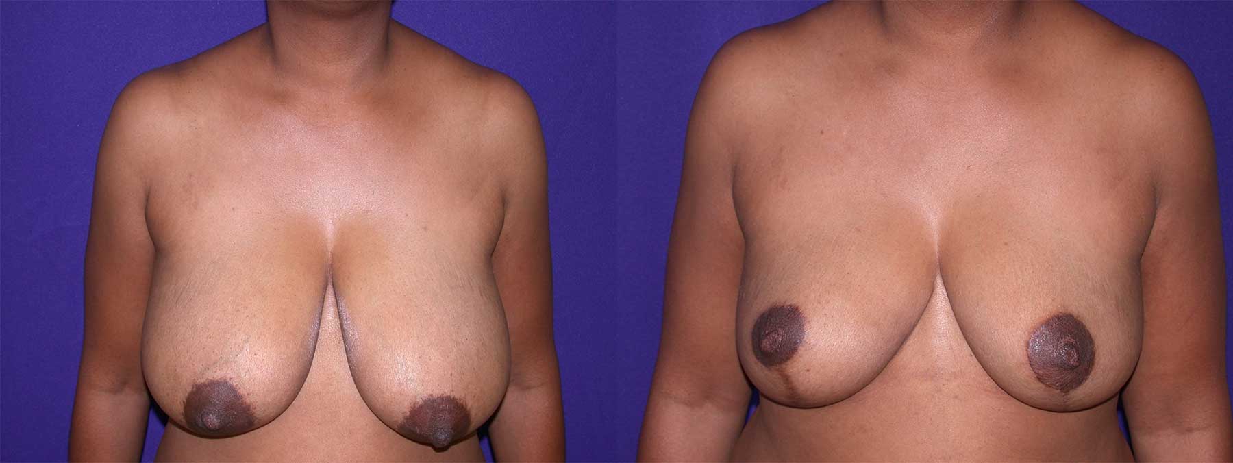 Before and After Image of Breast Reduction