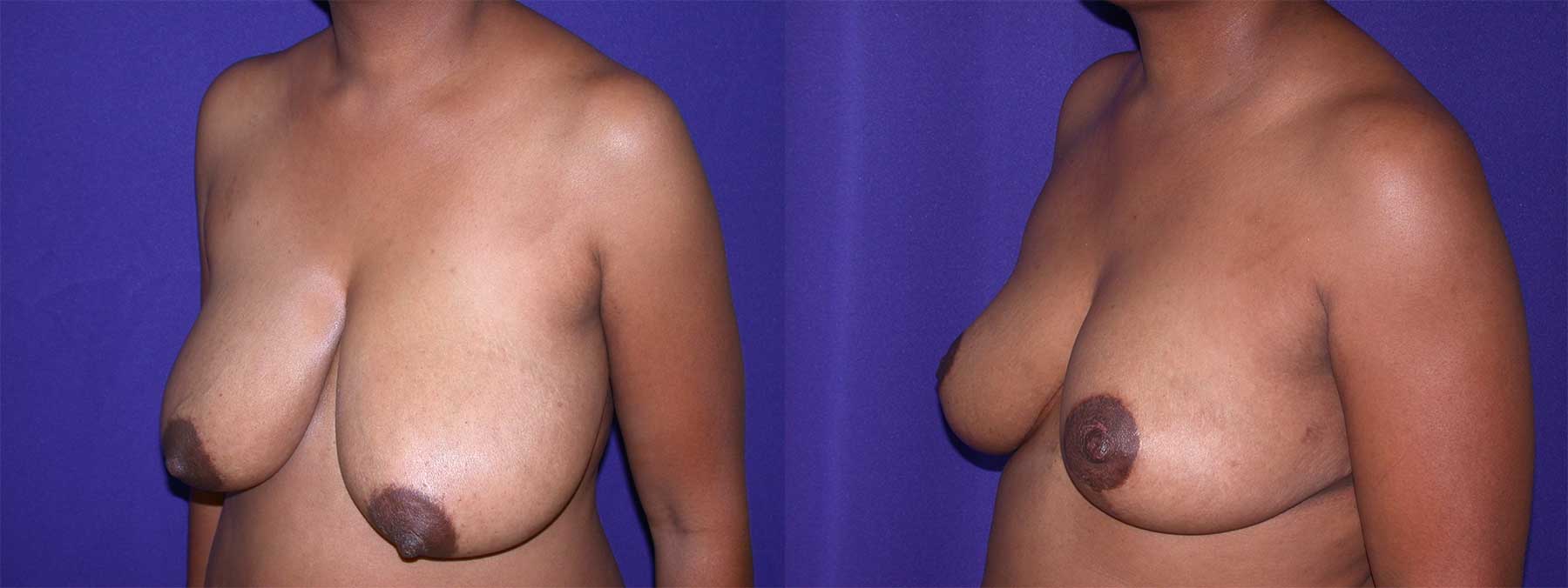 Before and After Image of Breast Reduction