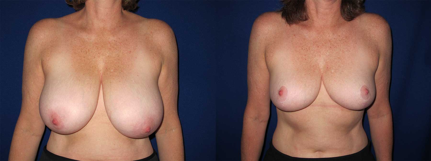 Before and After Image of Breast Reduction