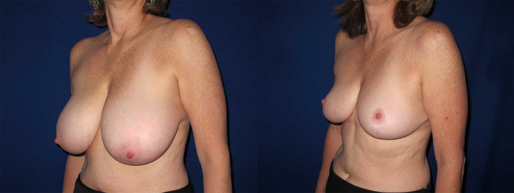 Before and After Image of Breast Reduction