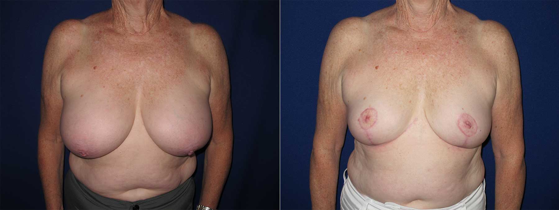 Before and After Image of Breast Reduction