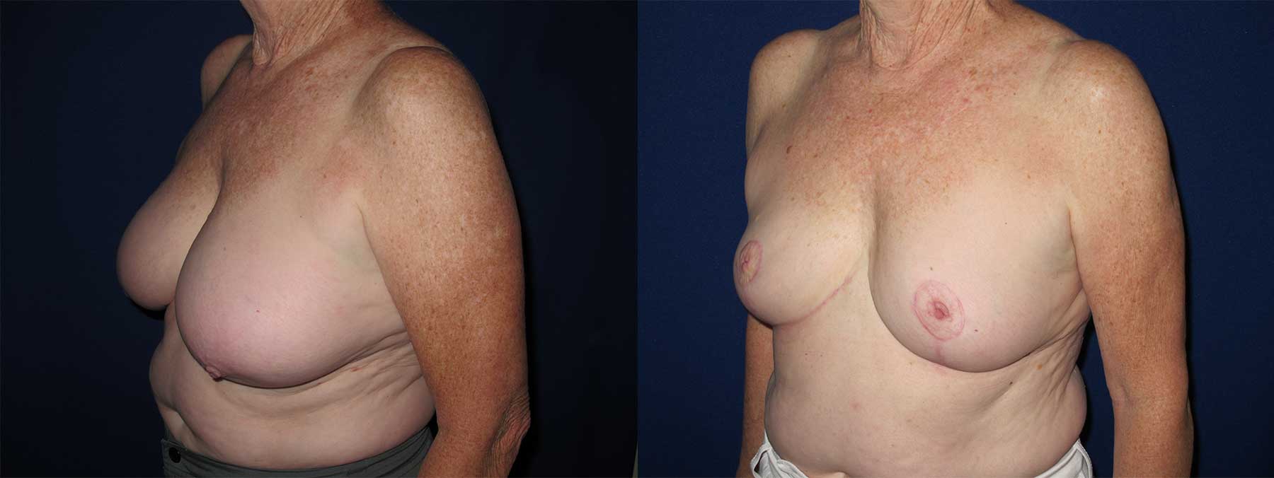 Before and After Image of Breast Reduction