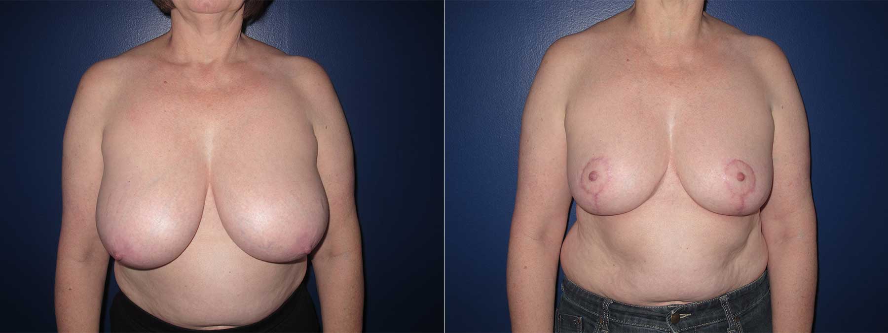 Before and After Image of Breast Reduction