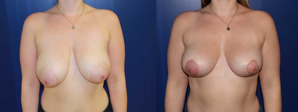 Before and After Image of Breast Reduction
