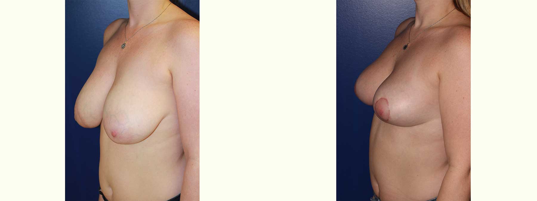 Before and After Image of Breast Reduction