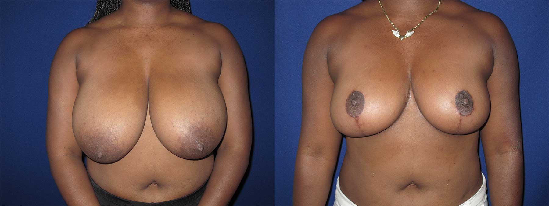 Before and After Image of Breast Reduction