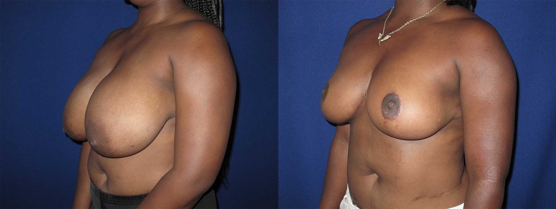 Before and After Image of Breast Reduction