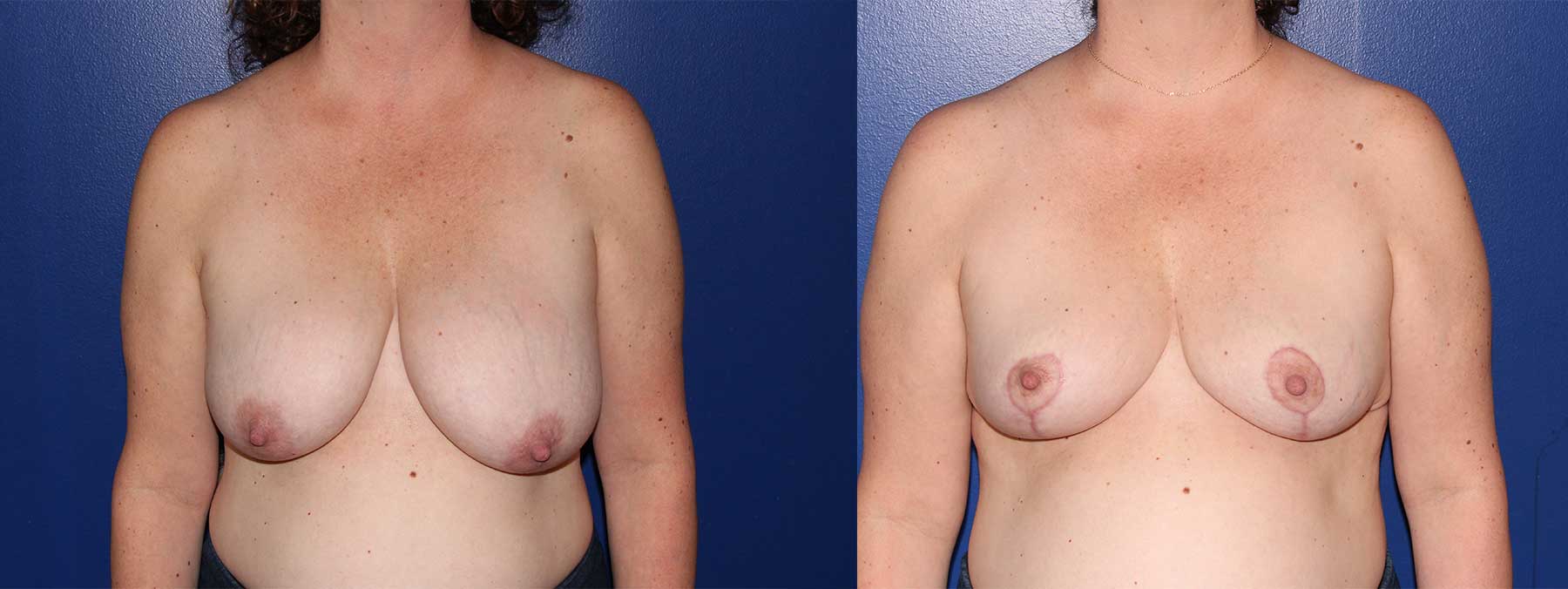 Before and After Image of Breast Reduction